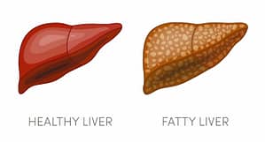 What is Fatty Liver